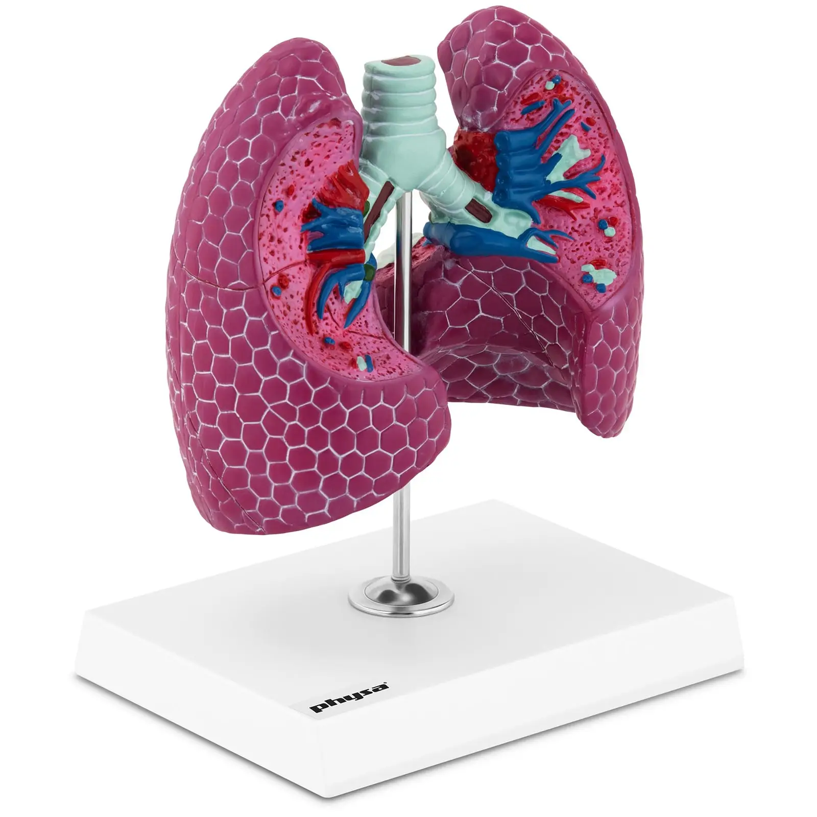 Chore płuca człowieka - model anatomiczny